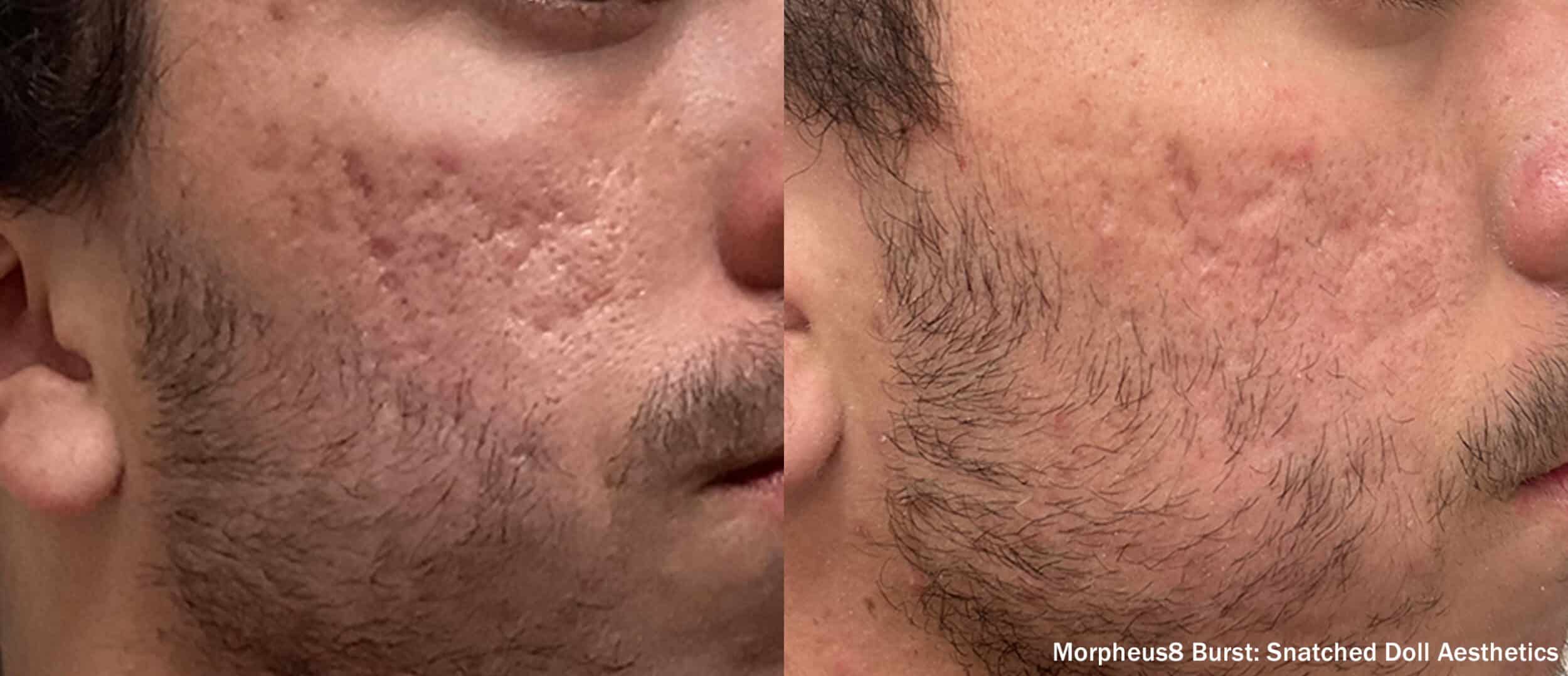Before and After Image: Morpheus8 - right-front-oblique
