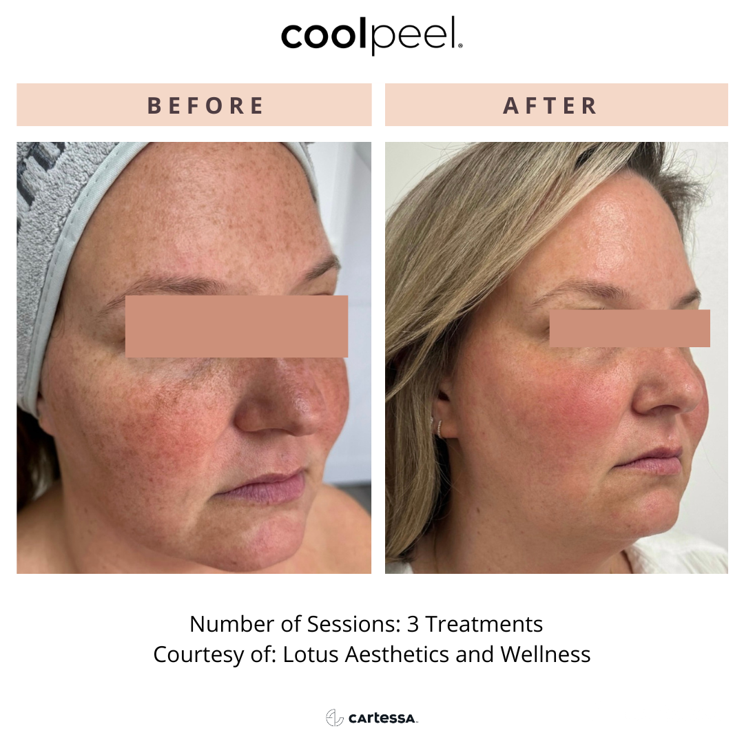 Before and After Image: CoolPeel - front