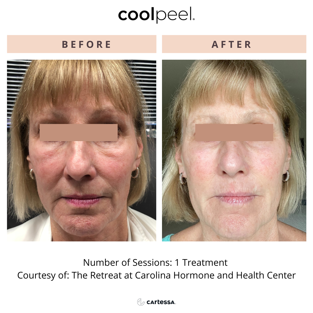 Before and After Image: CoolPeel - front