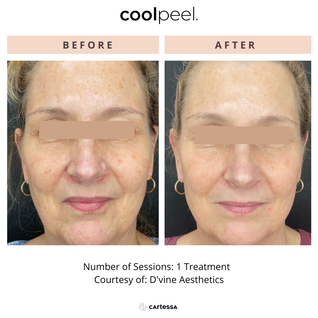 Before and After Image: CoolPeel - front