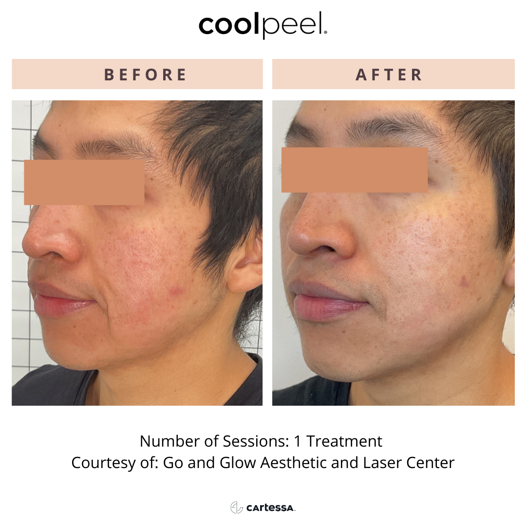 Before and After Image: CoolPeel - front