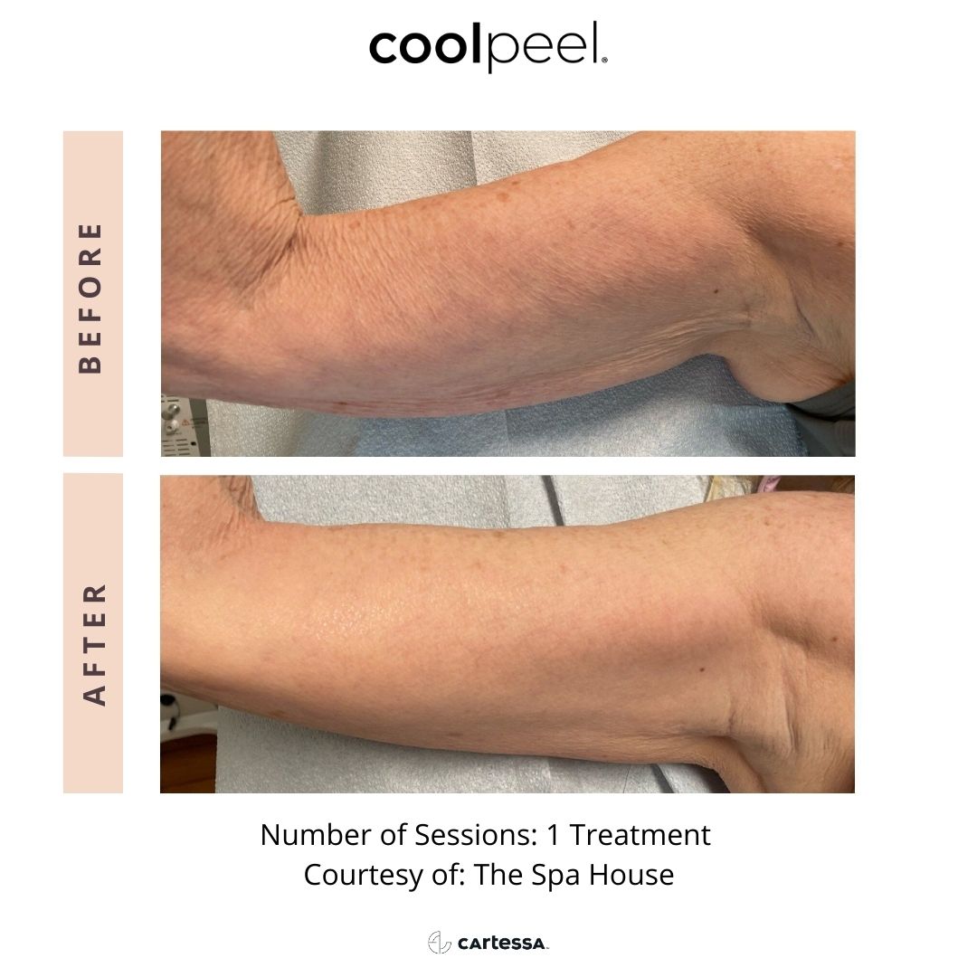 Before and After Image: CoolPeel - front