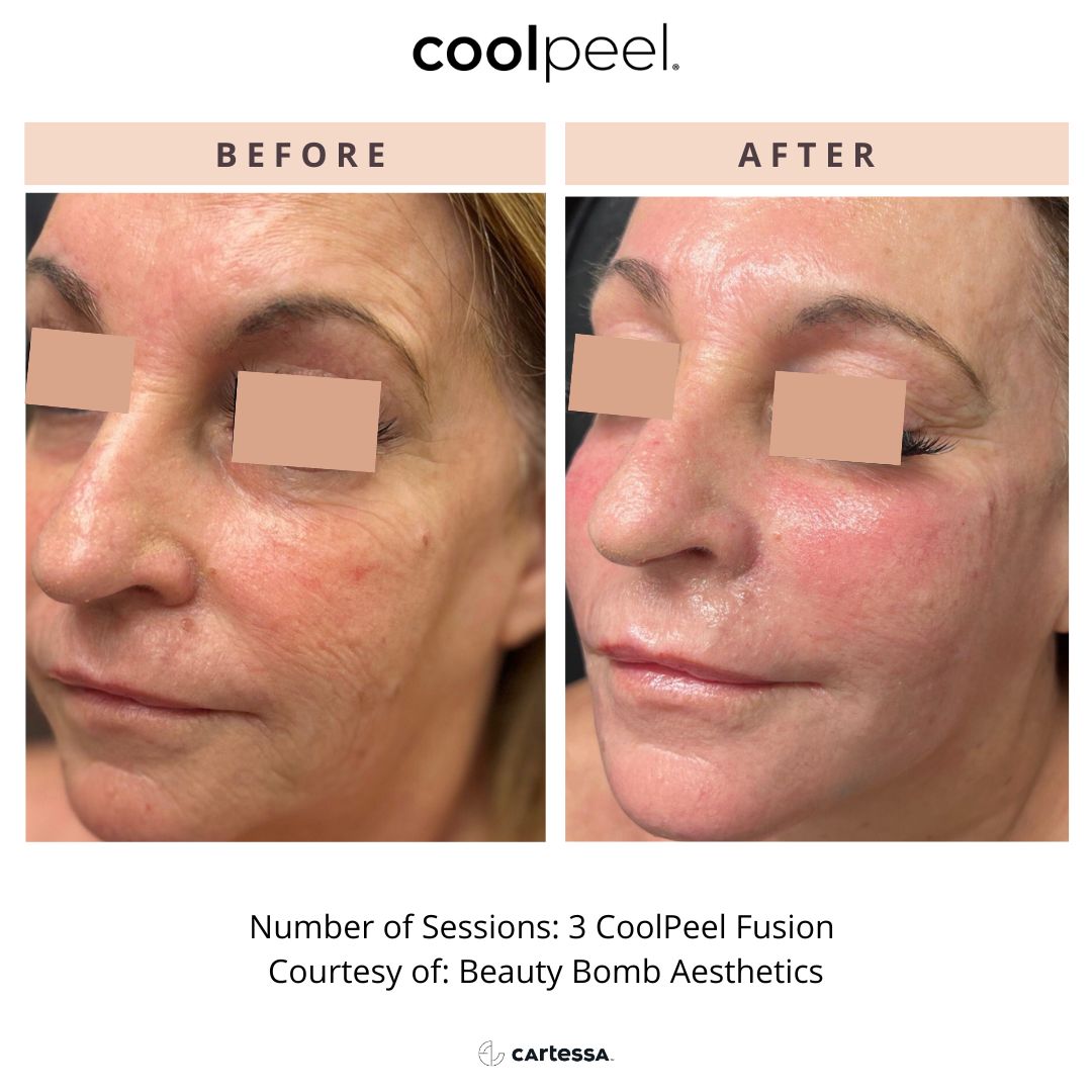 Before and After Image: CoolPeel - front