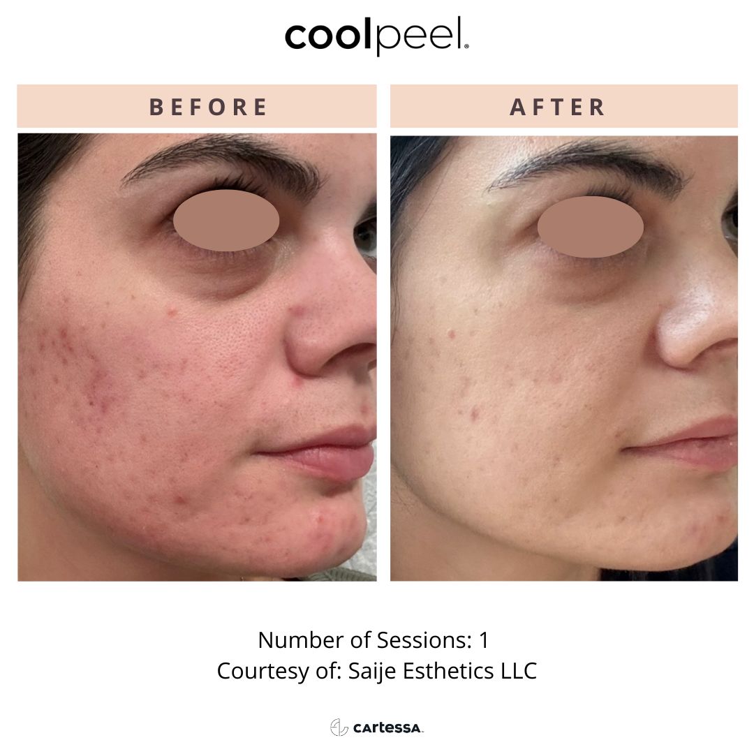 Before and After Image: CoolPeel - front