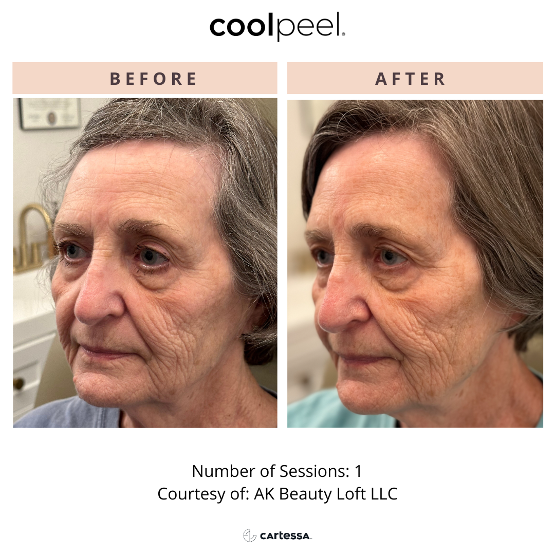 Before and After Image: CoolPeel - front