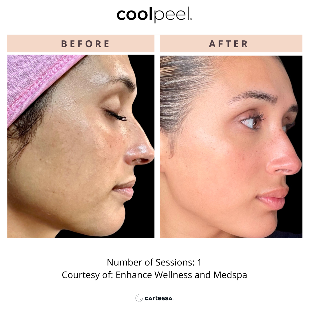 Before and After Image: CoolPeel - front