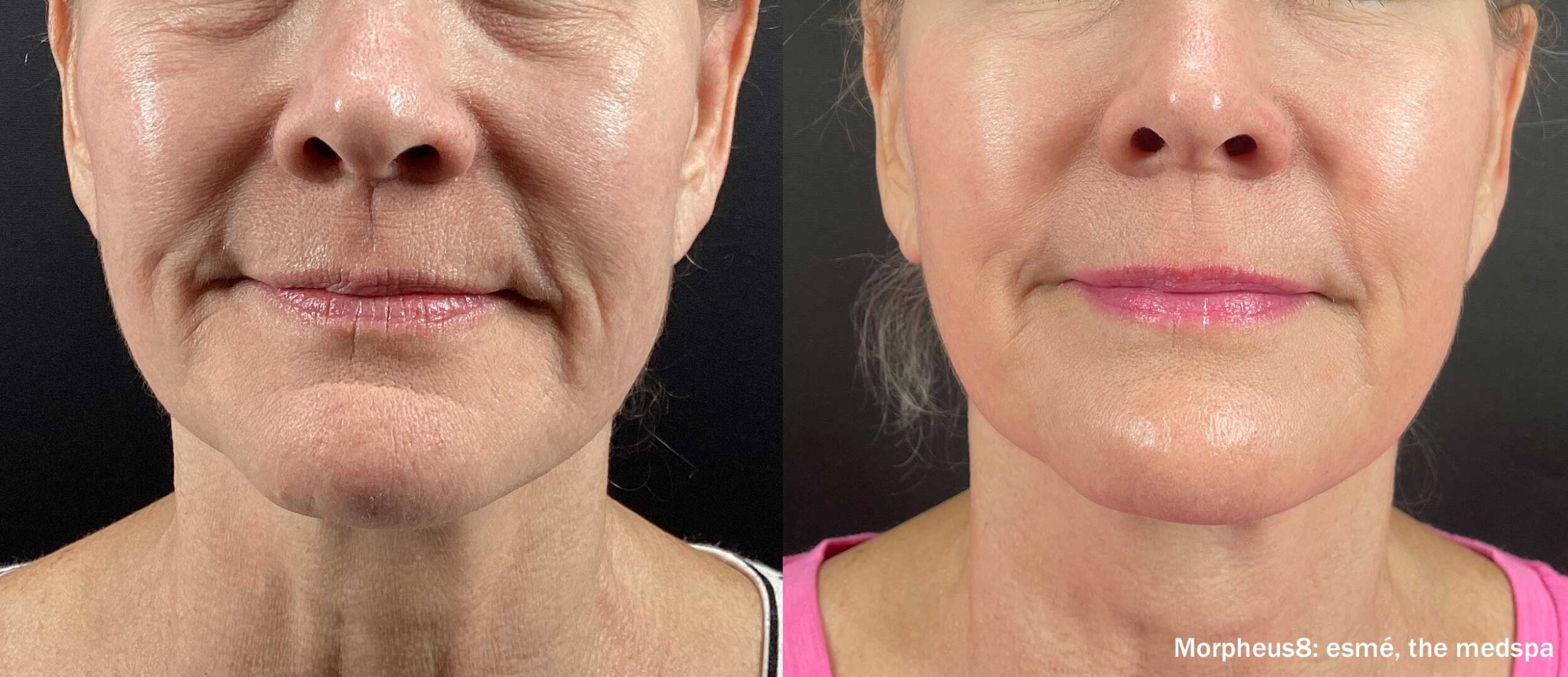 Before and After Image: Morpheus8 - front