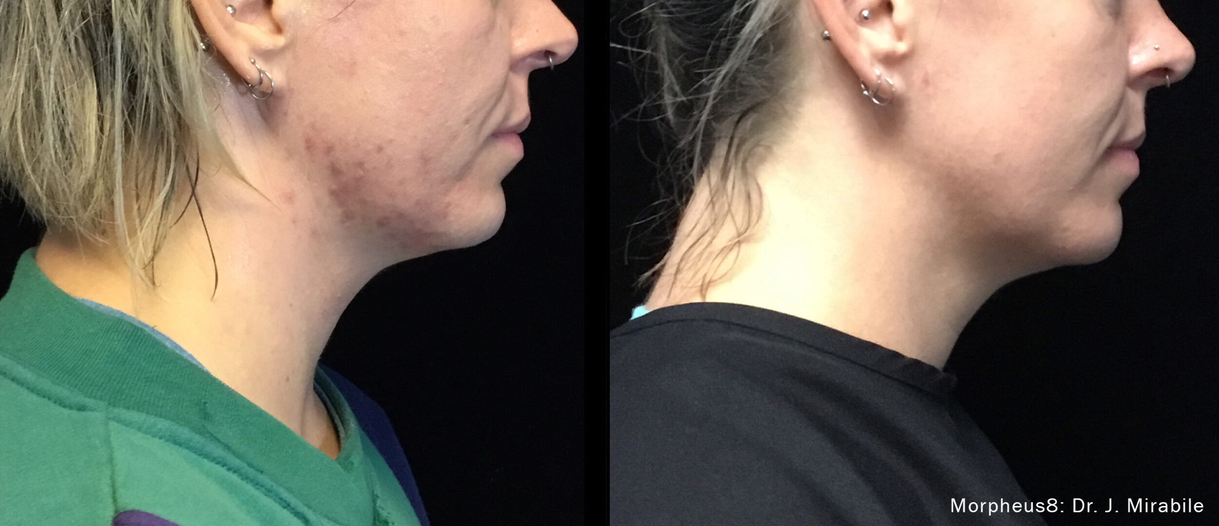 Before and After Image: Morpheus8 - front