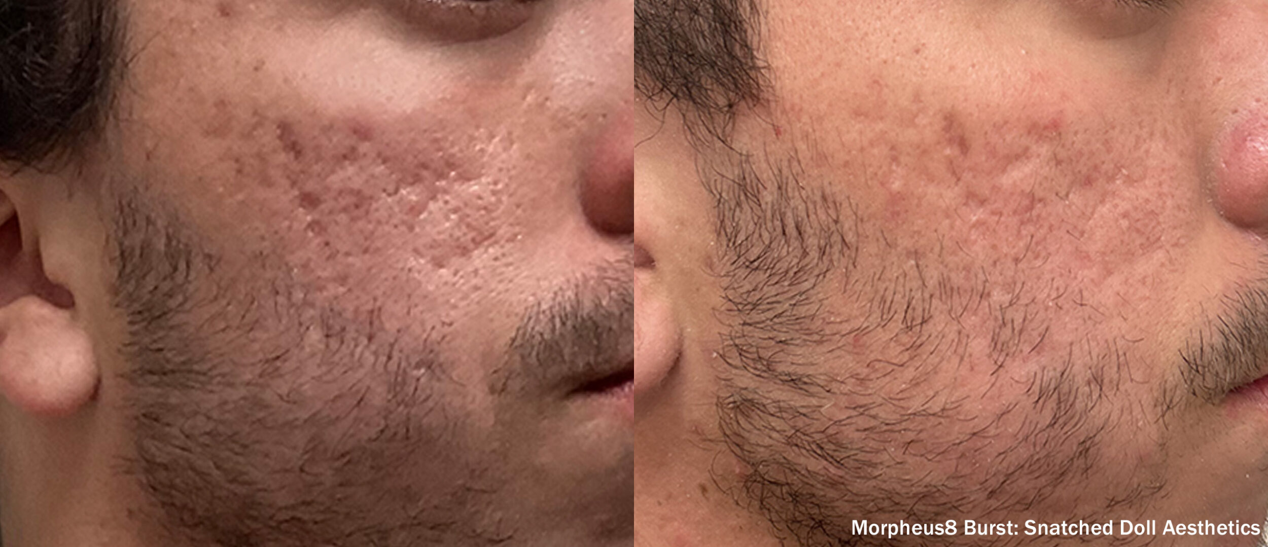 Before and After Image: Morpheus8 - front