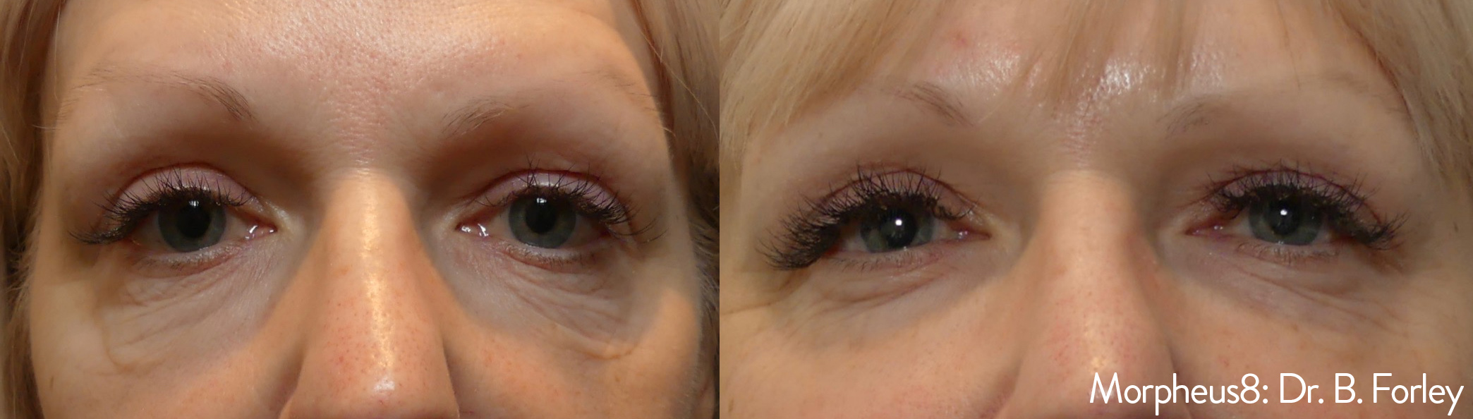 Before and After Image: Morpheus8 - front