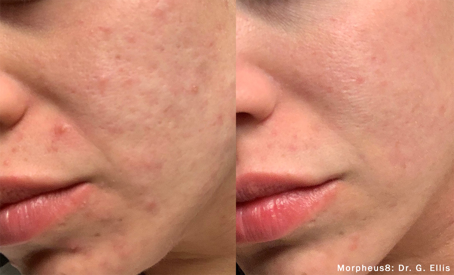 Before and After Image: Morpheus8 - front