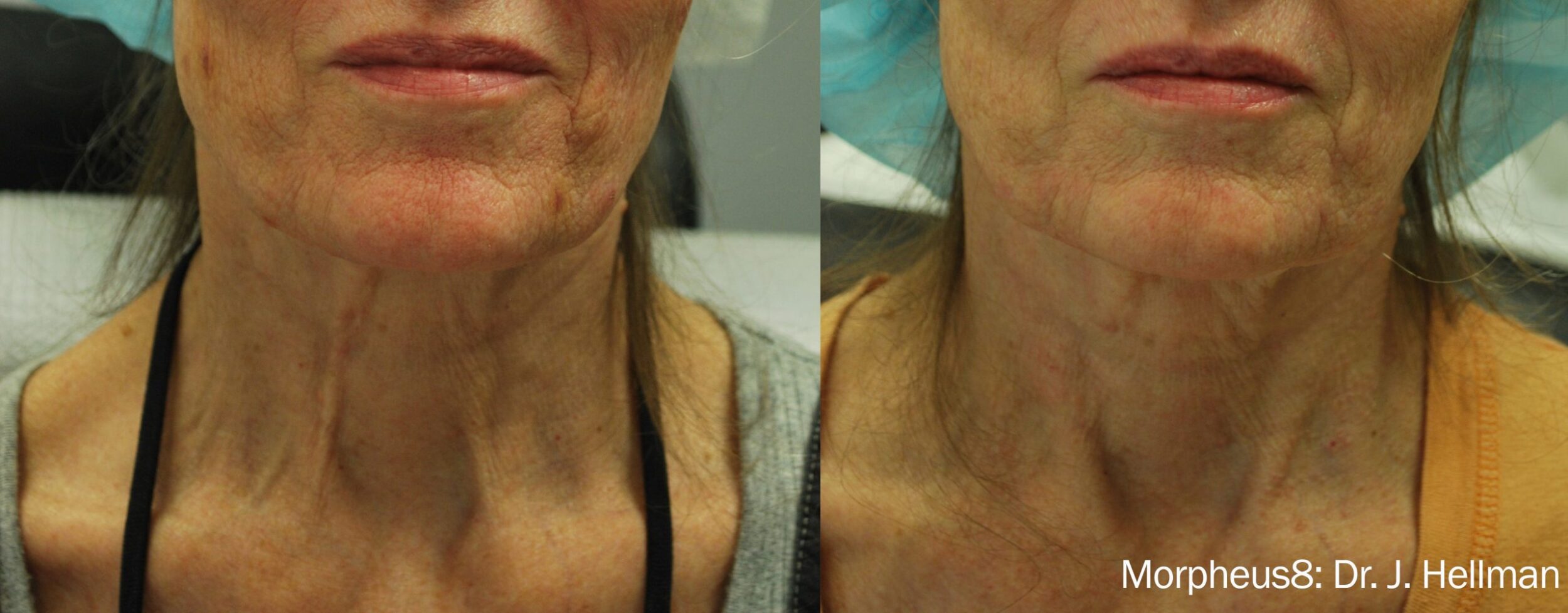 Before and After Image: Morpheus8 - front