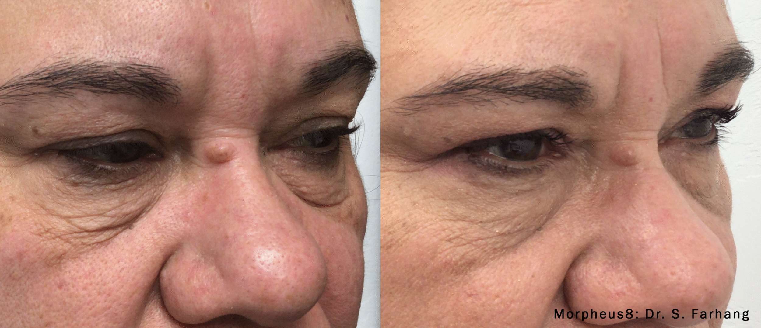 Before and After Image: Morpheus8 - front