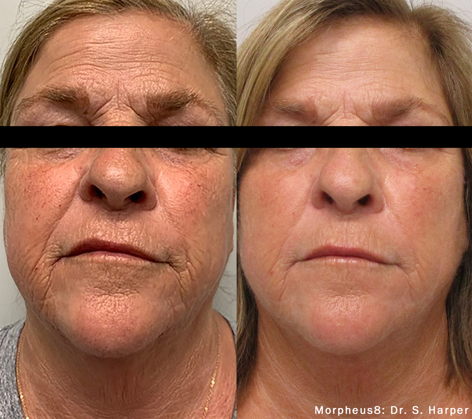 Before and After Image: Morpheus8 - front